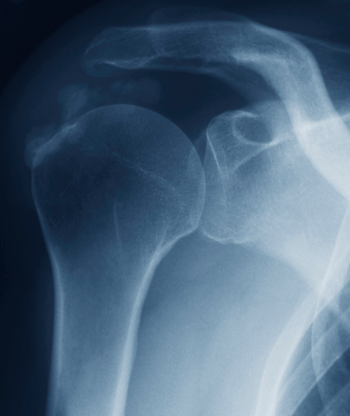 Tendinopathie calcifiante de l’épaule - Illustration médicale